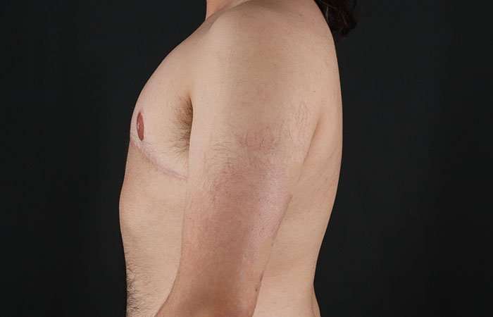Female To Male Breast Before & After Patient #4042