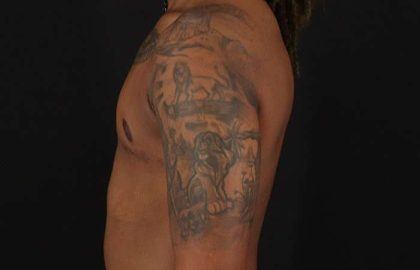 Female To Male Breast Before & After Patient #4053