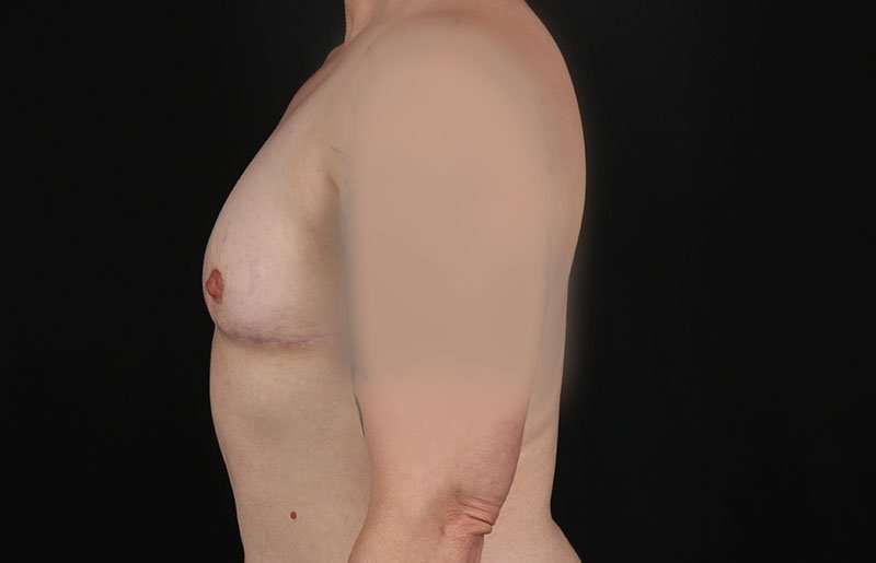 Female To Male Breast Before & After Patient #4064