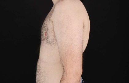 Female To Male Breast Before & After Patient #4075