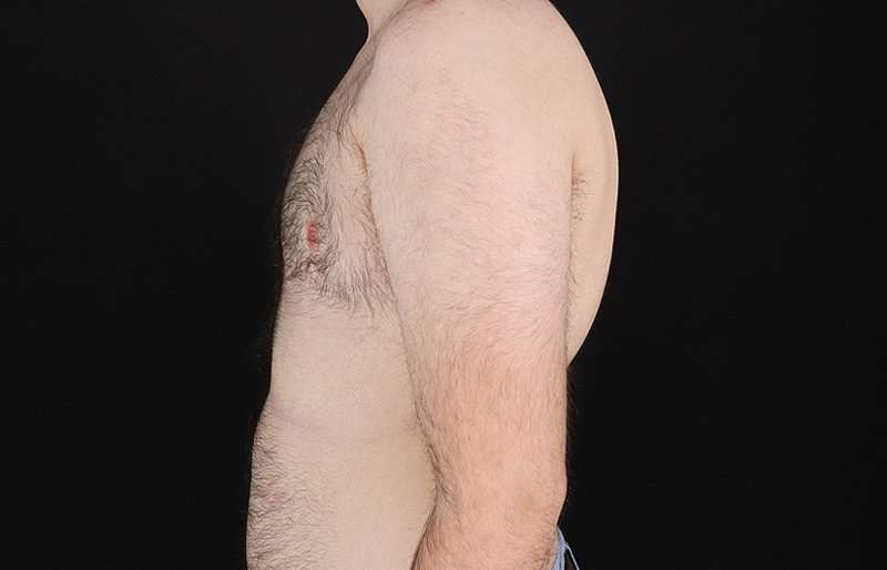 Female To Male Breast Before & After Patient #4075