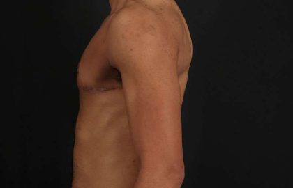 Female To Male Breast Before & After Patient #4086