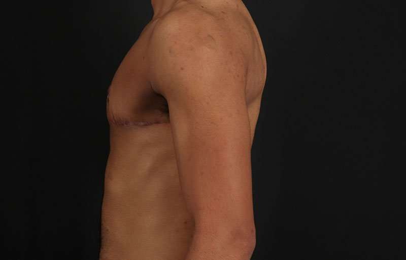 Female To Male Breast Before & After Patient #4086