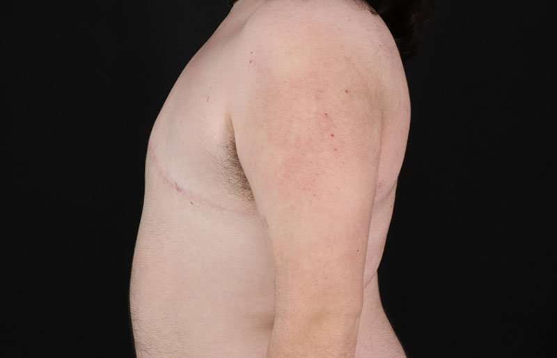 Female To Male Breast Before & After Patient #4097