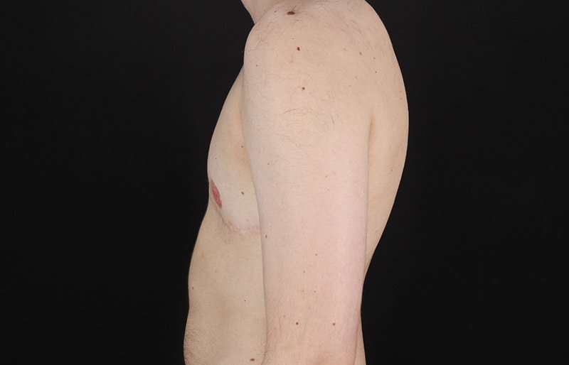 Female To Male Breast Before & After Patient #4108