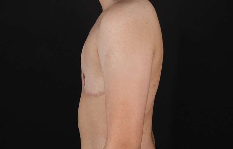 Female To Male Breast Before & After Patient #4119