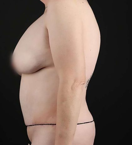 Abdominoplasty (Tummy Tuck) Before & After Patient #948