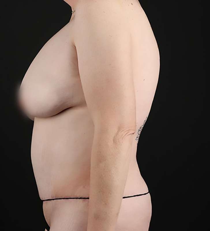 Abdominoplasty (Tummy Tuck) Before & After Patient #948