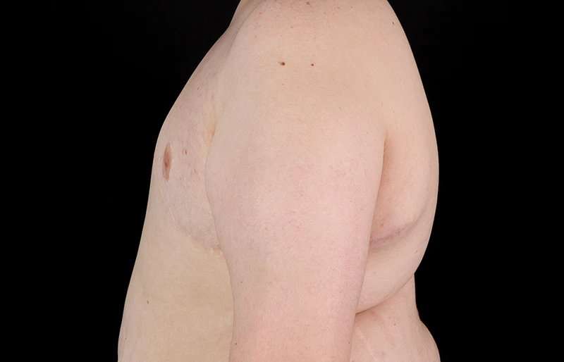 Female To Male Breast Before & After Patient #4130