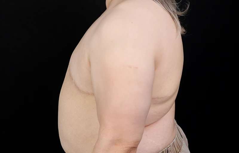 Female To Male Breast Before & After Patient #4141