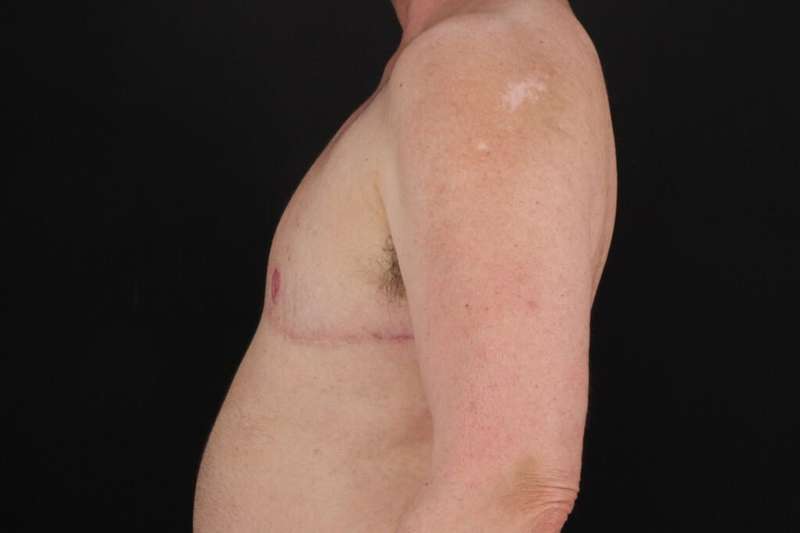 Female To Male Breast Before & After Patient #4152