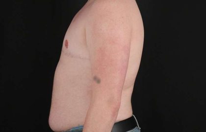 Female To Male Breast Before & After Patient #4163