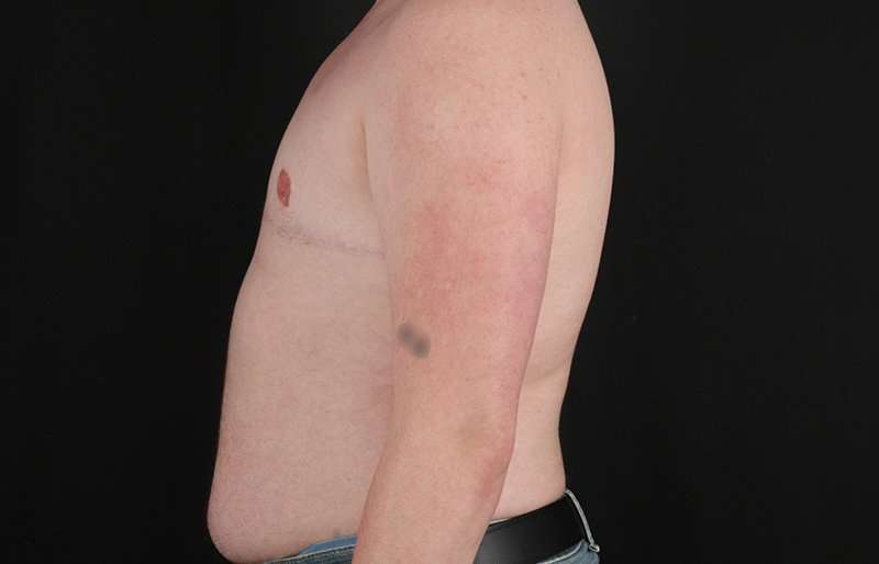 Female To Male Breast Before & After Patient #4163