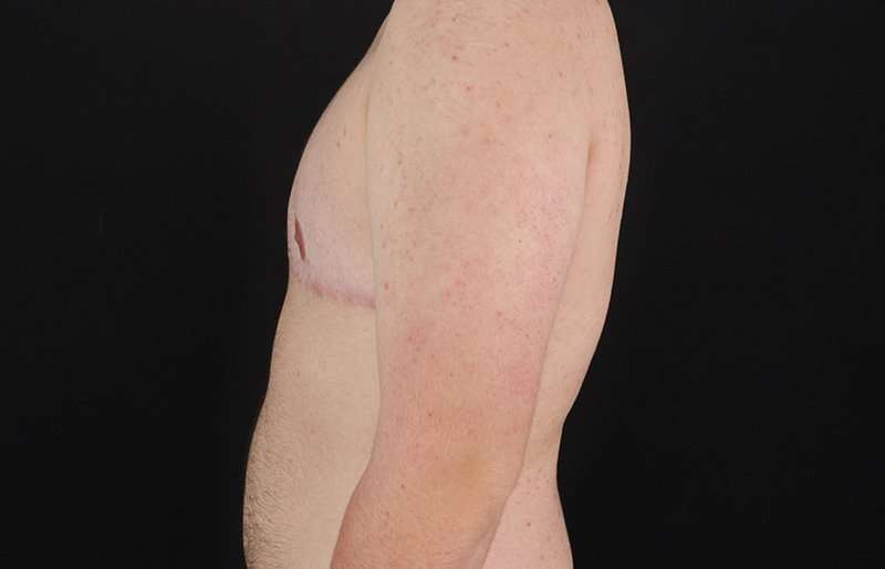 Female To Male Breast Before & After Patient #4174