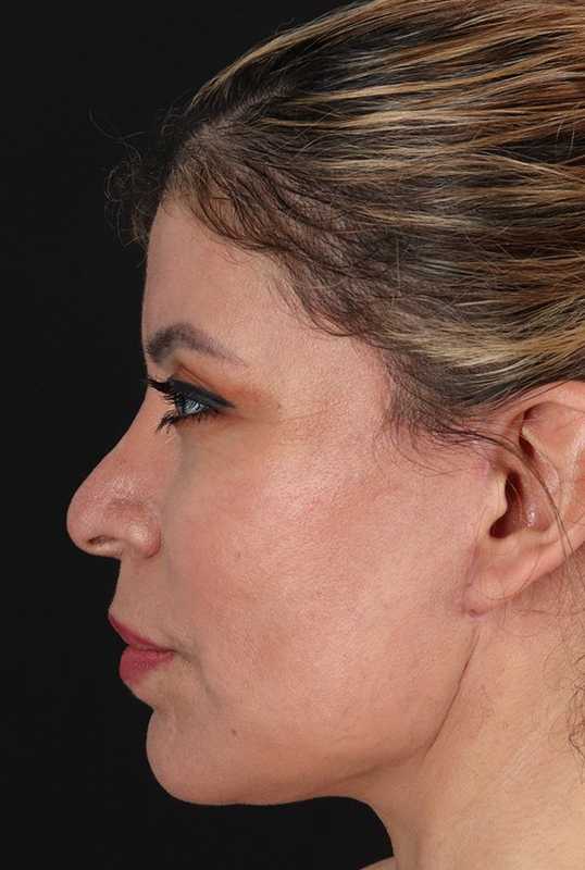 Fat Grafting To The Face Before & After Patient #4188