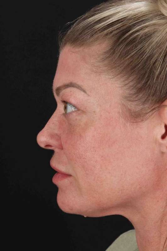 Fat Grafting To The Face Before & After Patient #4232
