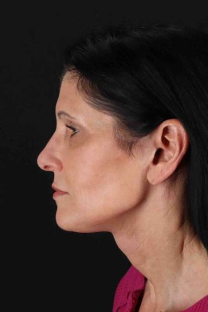 Fat Grafting To The Face Before & After Patient #4254