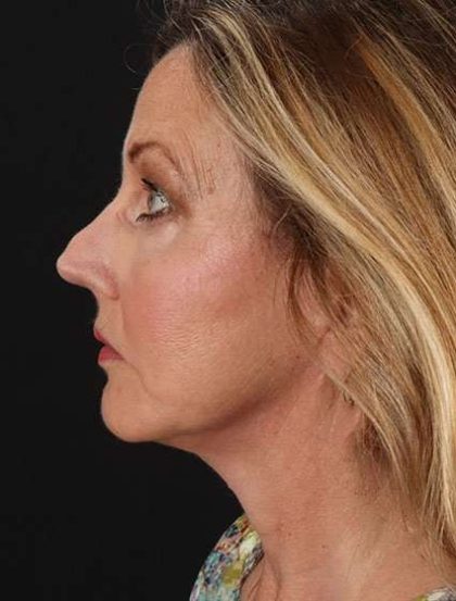 Fat Grafting To The Face Before & After Patient #4265