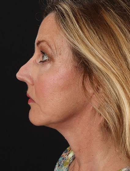 Fat Grafting To The Face Before & After Patient #4265
