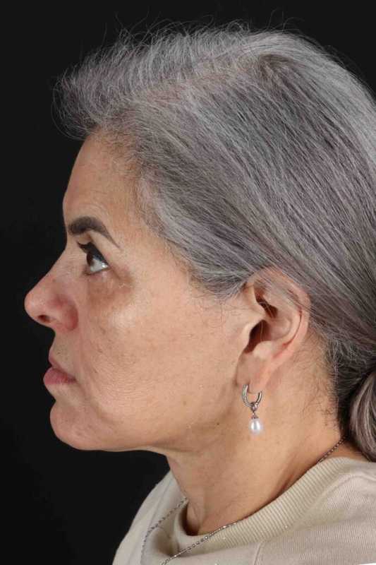 Fat Grafting To The Face Before & After Patient #4283