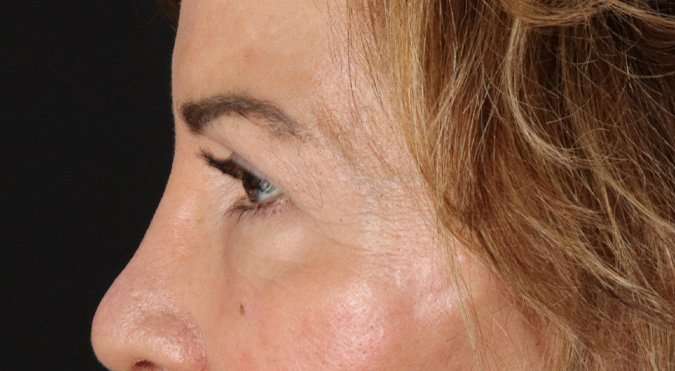 Blepharoplasty (Eyelid Surgery) Before & After Patient #4316