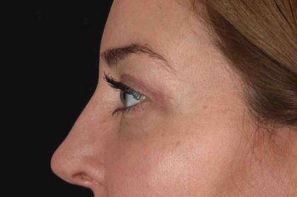 Blepharoplasty (Eyelid Surgery) Before & After Patient #4338