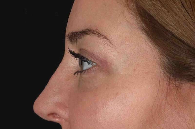 Blepharoplasty (Eyelid Surgery) Before & After Patient #4338