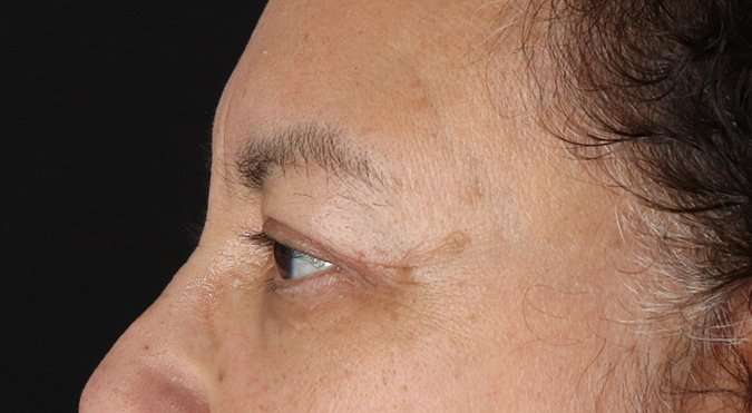 Blepharoplasty (Eyelid Surgery) Before & After Patient #4349