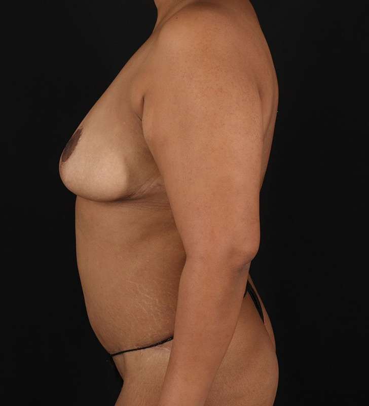 Abdominoplasty (Tummy Tuck) Before & After Patient #975