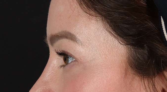Blepharoplasty (Eyelid Surgery) Before & After Patient #4360