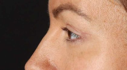 Blepharoplasty (Eyelid Surgery) Before & After Patient #4371