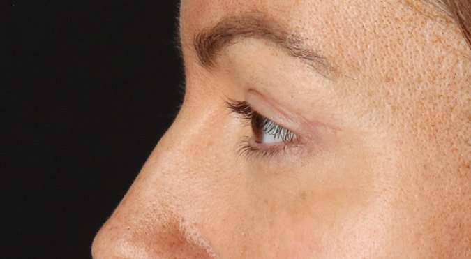 Blepharoplasty (Eyelid Surgery) Before & After Patient #4371