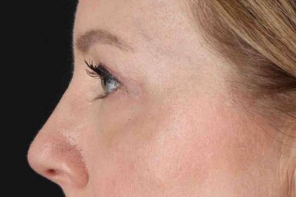 Blepharoplasty (Eyelid Surgery) Before & After Patient #4382