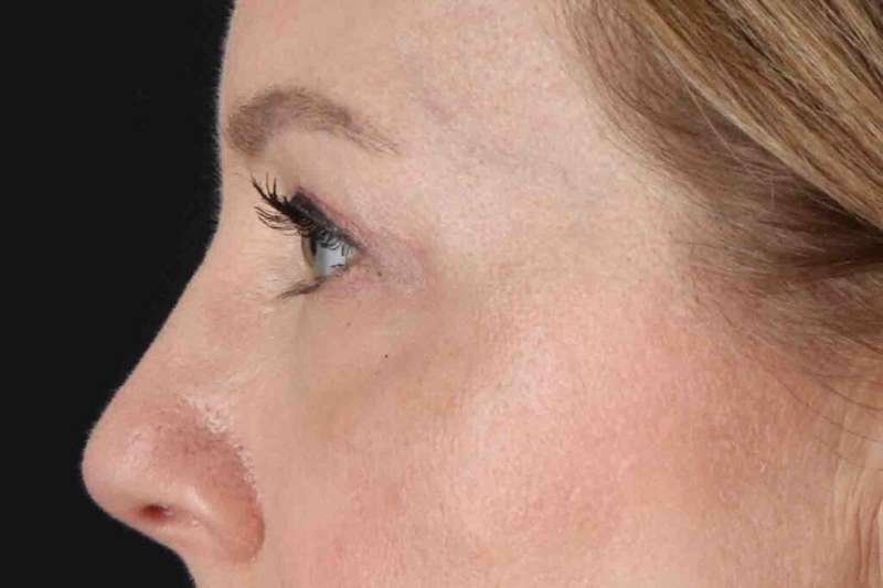 Blepharoplasty (Eyelid Surgery) Before & After Patient #4382
