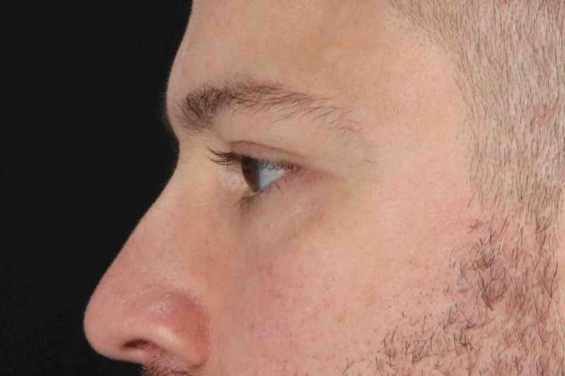 Blepharoplasty (Eyelid Surgery) Before & After Patient #4393