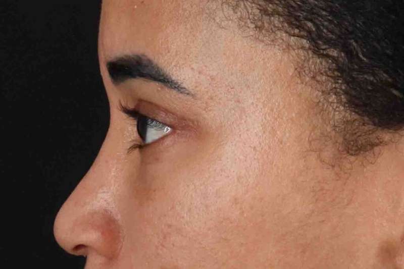 Blepharoplasty (Eyelid Surgery) Before & After Patient #4404