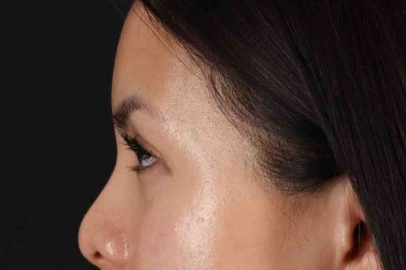 Blepharoplasty (Eyelid Surgery) Before & After Patient #4415