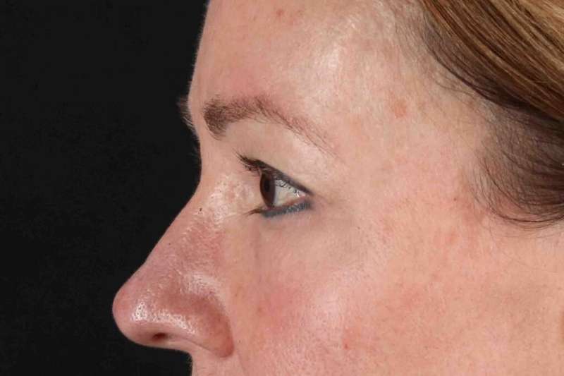 Blepharoplasty (Eyelid Surgery) Before & After Patient #4426