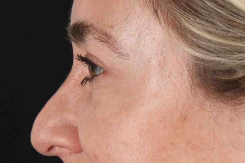 Blepharoplasty (Eyelid Surgery) Before & After Patient #4437