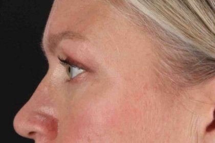 Blepharoplasty (Eyelid Surgery) Before & After Patient #4448