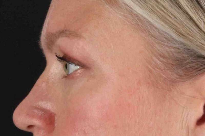 Blepharoplasty (Eyelid Surgery) Before & After Patient #4448