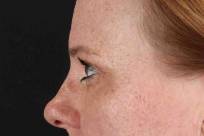 Blepharoplasty (Eyelid Surgery) Before & After Patient #4459