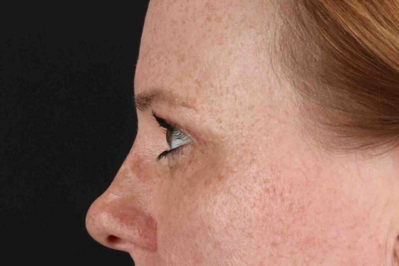 Blepharoplasty (Eyelid Surgery) Before & After Patient #4459