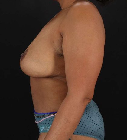 Abdominoplasty (Tummy Tuck) Before & After Patient #990
