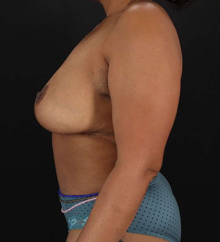 Abdominoplasty (Tummy Tuck) Before & After Patient #990