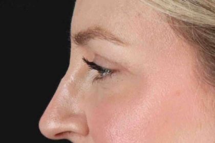 Blepharoplasty (Eyelid Surgery) Before & After Patient #4470