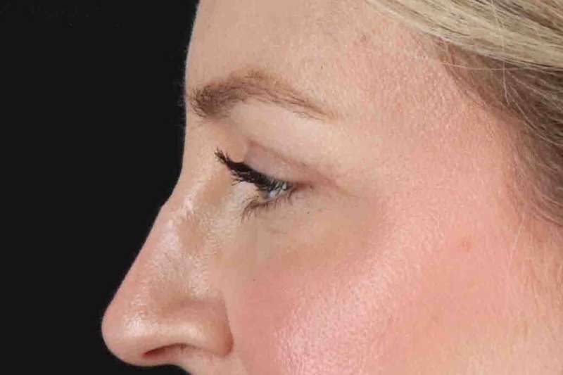 Blepharoplasty (Eyelid Surgery) Before & After Patient #4470