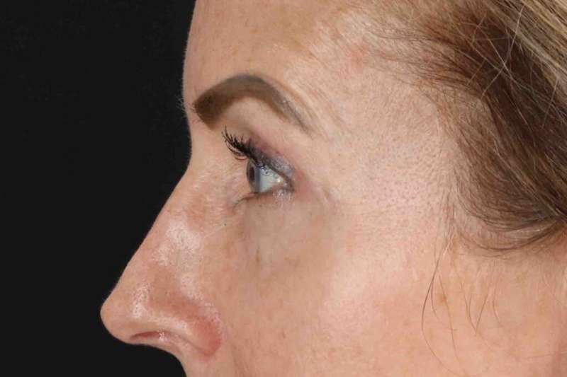 Blepharoplasty (Eyelid Surgery) Before & After Patient #4481