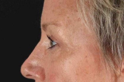 Blepharoplasty (Eyelid Surgery) Before & After Patient #4492