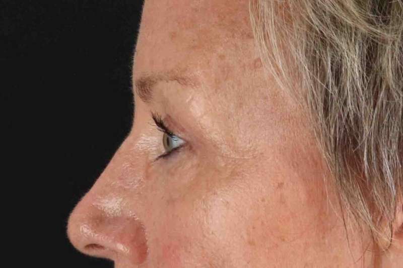 Blepharoplasty (Eyelid Surgery) Before & After Patient #4492